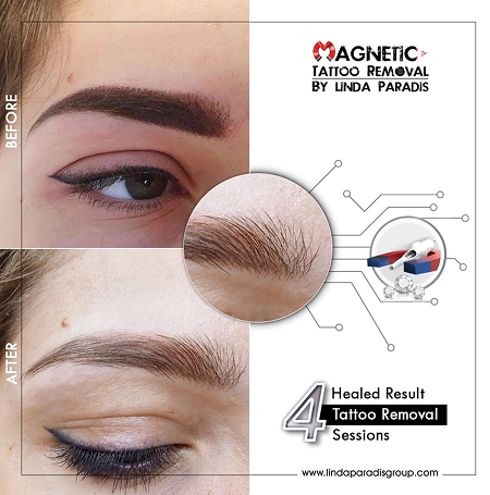 Magnetic Tattoo Removal