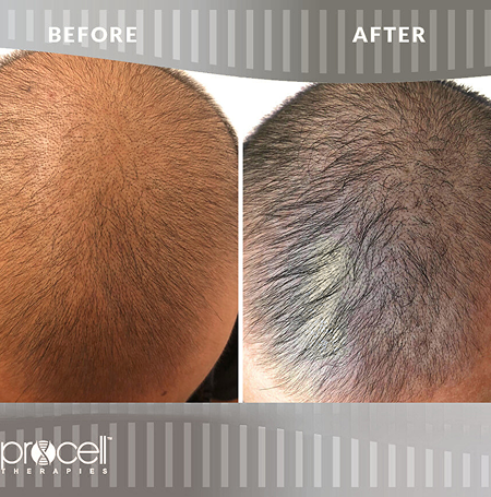 Procell Hair Restoration